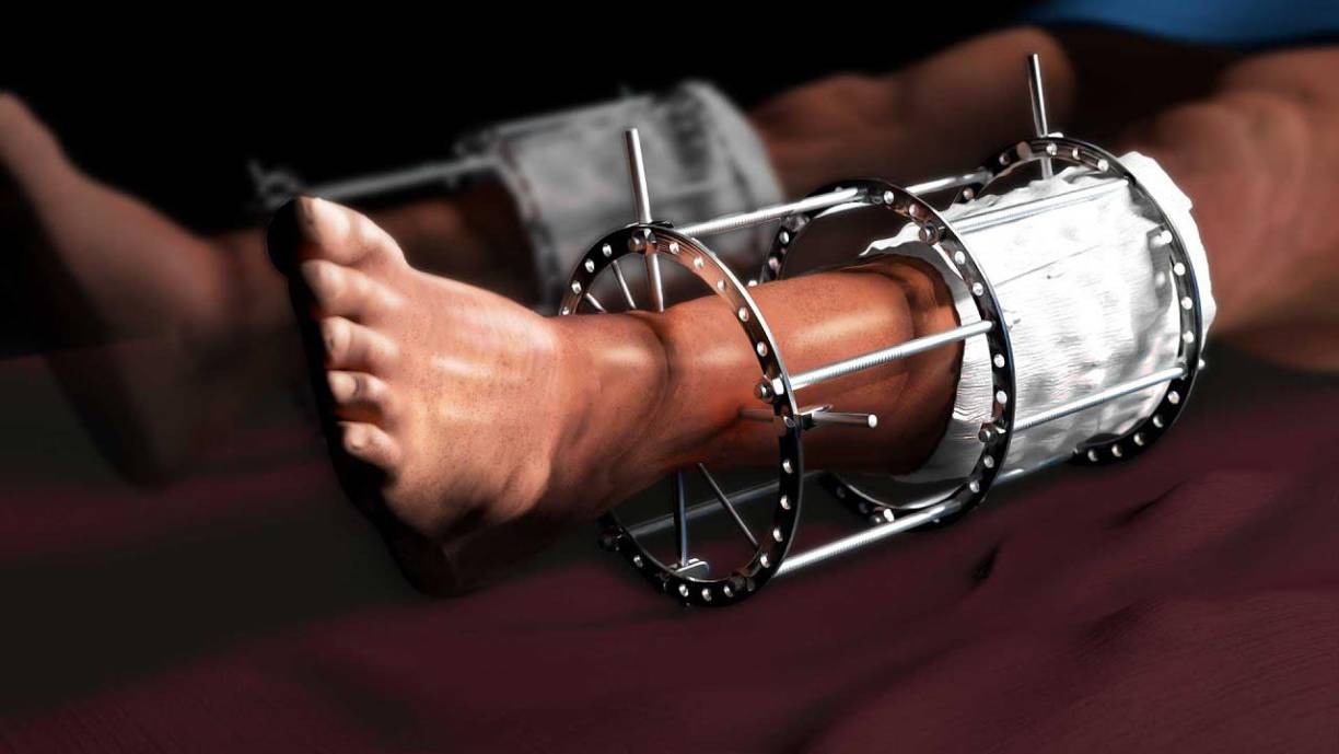 En las imágenes se logra apreciar que Cossio realiza terapia suspendido en el aire con un arnés, guiado por uno de los especialistas, que ayuda también en los cortos desplazamientos que hace con sus piernas y en su rostro se observa el dolor que le produce. De igual forma, se observó que ha perdido parte de la masa muscular que tenía en sus piernas, a causa de las largas jornadas de entrenamiento en el gimnasio.