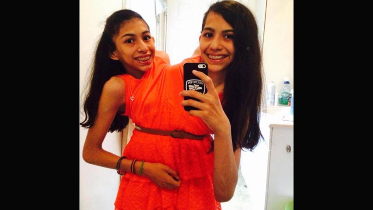 La intervención quirúrgica fue desestimada por los riesgos que conllevaba para Carmen y Lupita. Ante este inusual panorama, las siamesas no tuvieron más opción que aprender a compartir órganos, espacios y su vida en general.