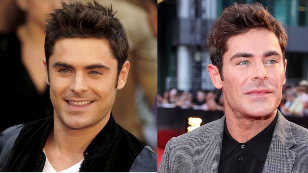 Han pasado 11 años desde que el actor Zac Efron sufrió un accidente que hizo que le reconstruyeran la mandíbula, pero es hasta ahora cuando los fans parecen notarlo tras el estreno de su nueva película “A Family Affair”, de Netflix. Luego de ver esta comedia romántica, en redes sociales no han parado de criticarlo por su aspecto, asumiendo que el exceso de botox arruinó la belleza que lo caracterizaba en su época donde protagonizó la serie “High School Musical”.