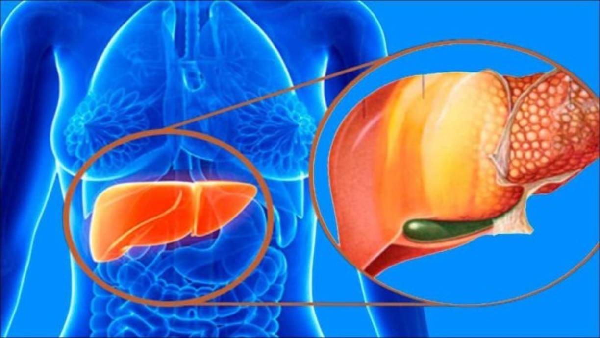 Este padecimiento se debe a la acumulación de ácidos grasos y triglicéridos en las células hepáticas, lo cual se produce principalmente por la obesidad, la diabetes y la hiperlipidemia (grasa en la sangre). Por lo general, no presenta síntomas. Cuando aparecen, incluyen fatiga, pérdida de peso y dolor abdominal.