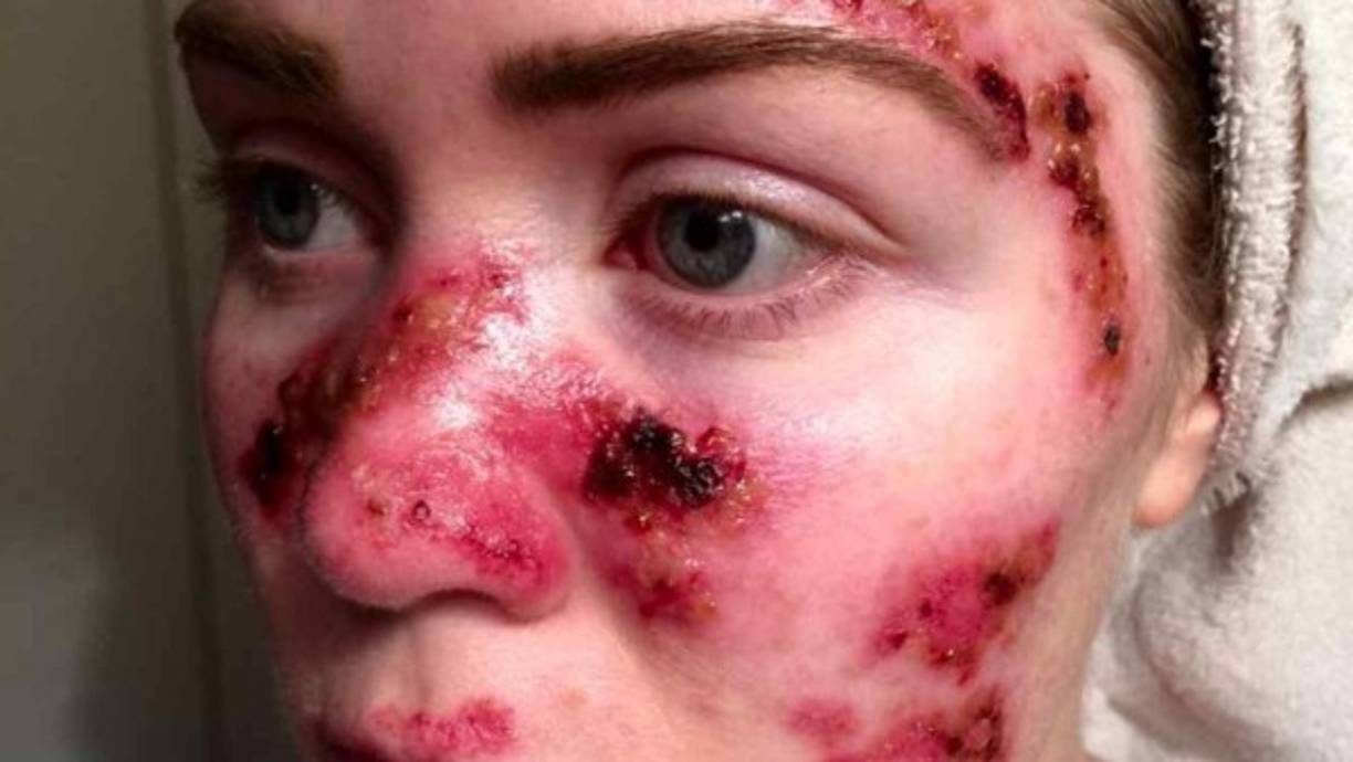 11.- Enfermedades de la piel<br/><br/>El cáncer, especialmente en la piel, será una enfermedad muy común entre los seres humanos que sobrevivan a la catástrofe ya que estarán expuesos a la radiación solar y la radiación del ambiente producto de los átomos liberados por las explosiones de las bombas.