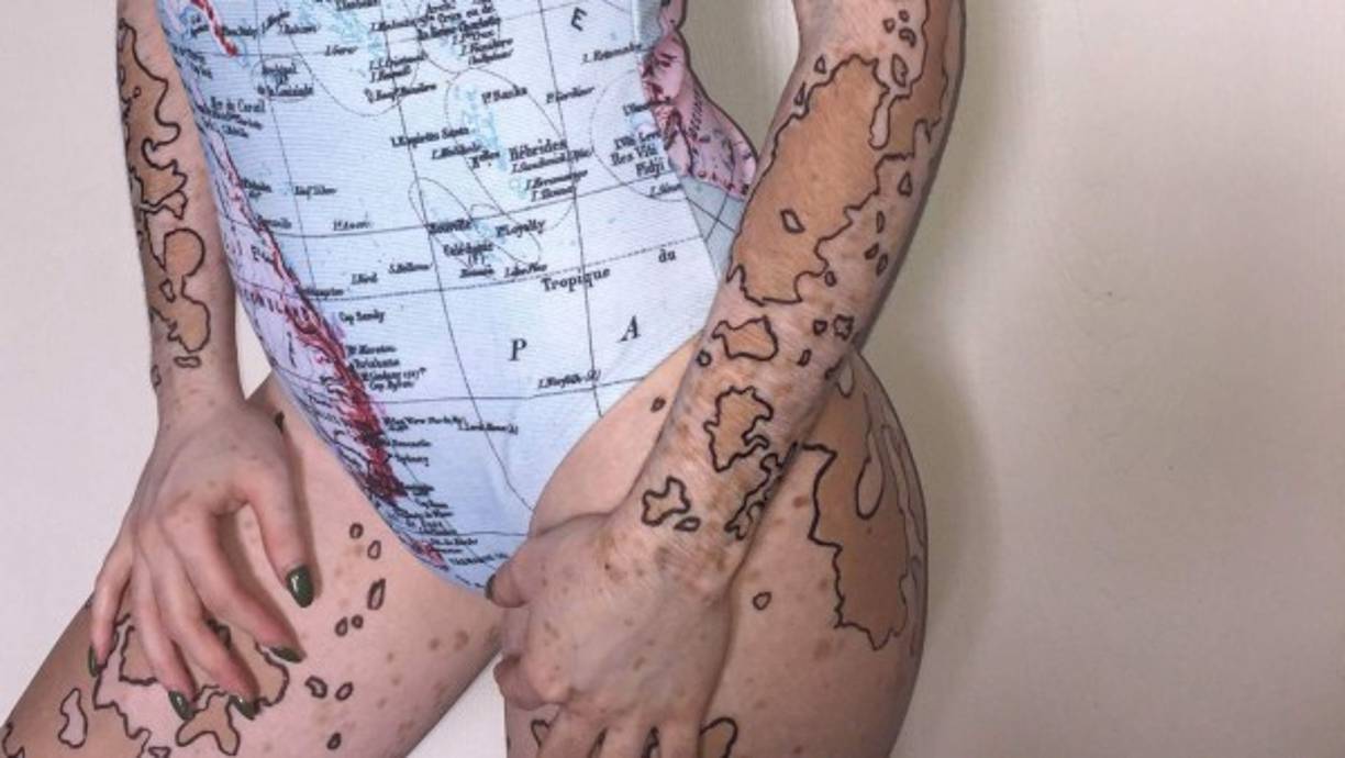 Ashley Soto es una joven que padece de Vitíligo, y utiliza su cuerpo para crear conciencia a las personas sobre esta enfermedad. Foto: Instagram