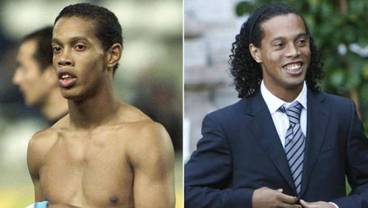 El brasileño Ronaldinho Gaucho es uno de los que se ha sometido a diferentes cirugías.