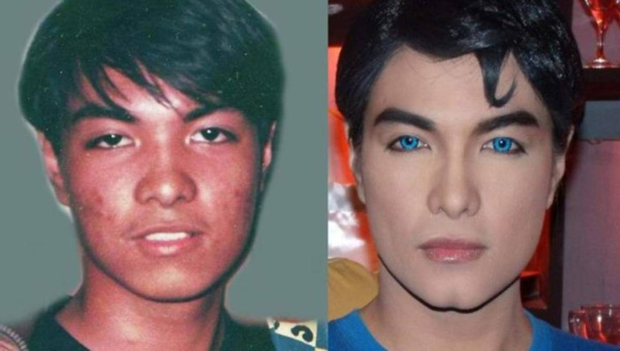 Herbert Chávez es un filipino que gastó más de 5.200 euros en 13 cirugías que incluyen blanqueamiento de piel, operaciones de nariz, implantes pectorales o liposucciones, para parecerse al personaje de Superman.