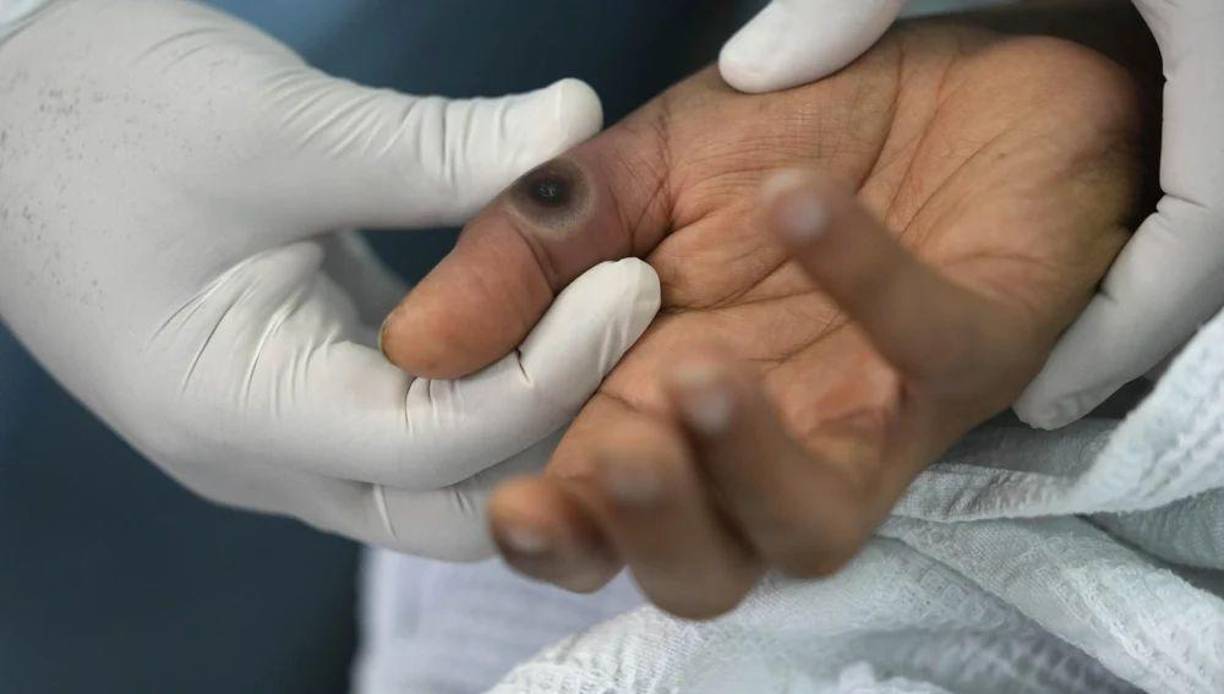 La viruela del mono también puede afectar a ciertos animales. Es importante evitar el contacto con animales enfermos. 