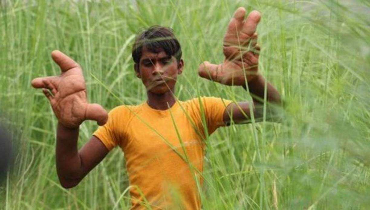 Tarik, cuya anormalidad en sus manos no ha sido diagnosticada, vive en la comunidad de Uttar Pradesh en la India. Imagen e información:Infobae