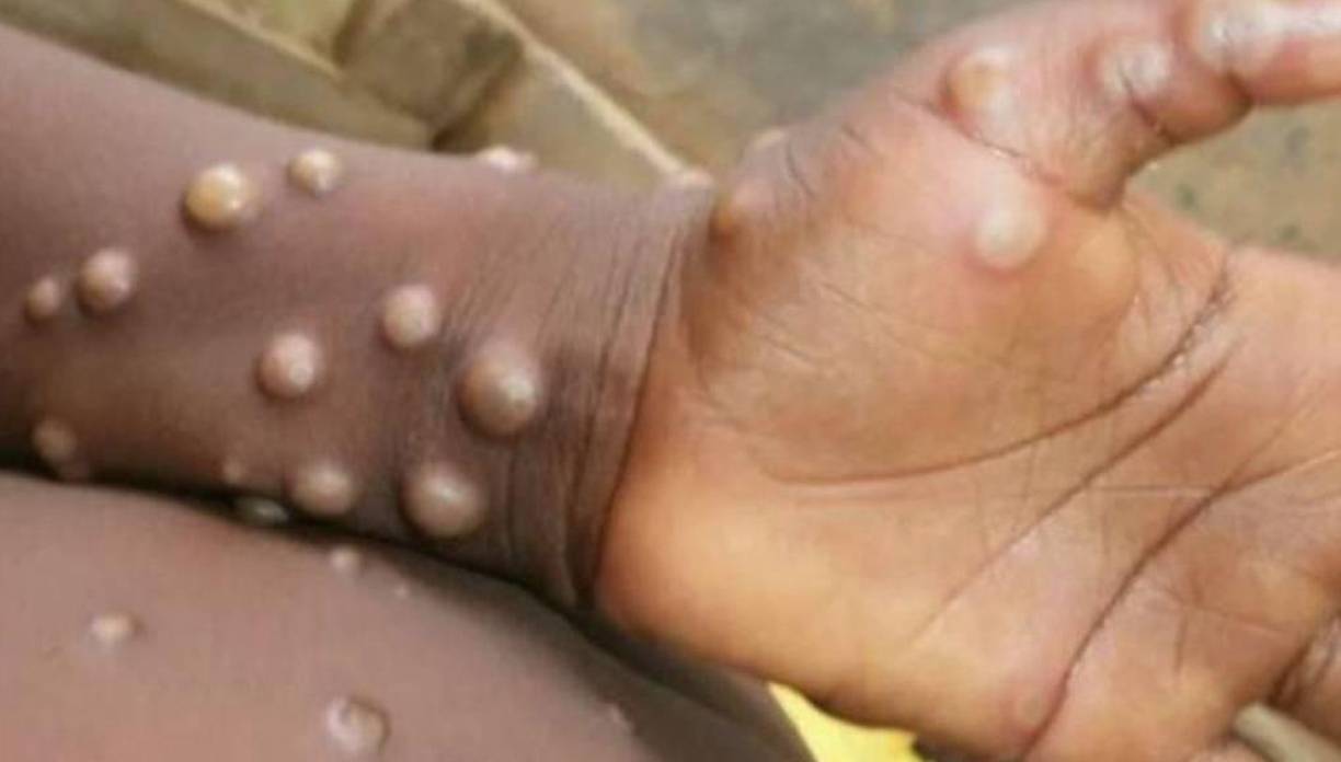 La experta en viruela de la OMS Rosamund Lewis añadió en la rueda de prensa que el hecho de que los casos se concentren por ahora casi exclusivamente en un solo colectivo puede ayudar al control del brote.