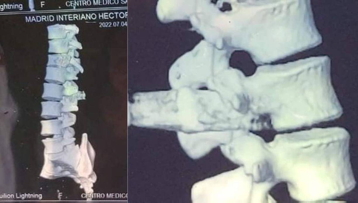 Ahora permanece todos los días en una silla de ruedas, pero una cirugía podría devolverme la movilidad en sus extremidades inferiores.