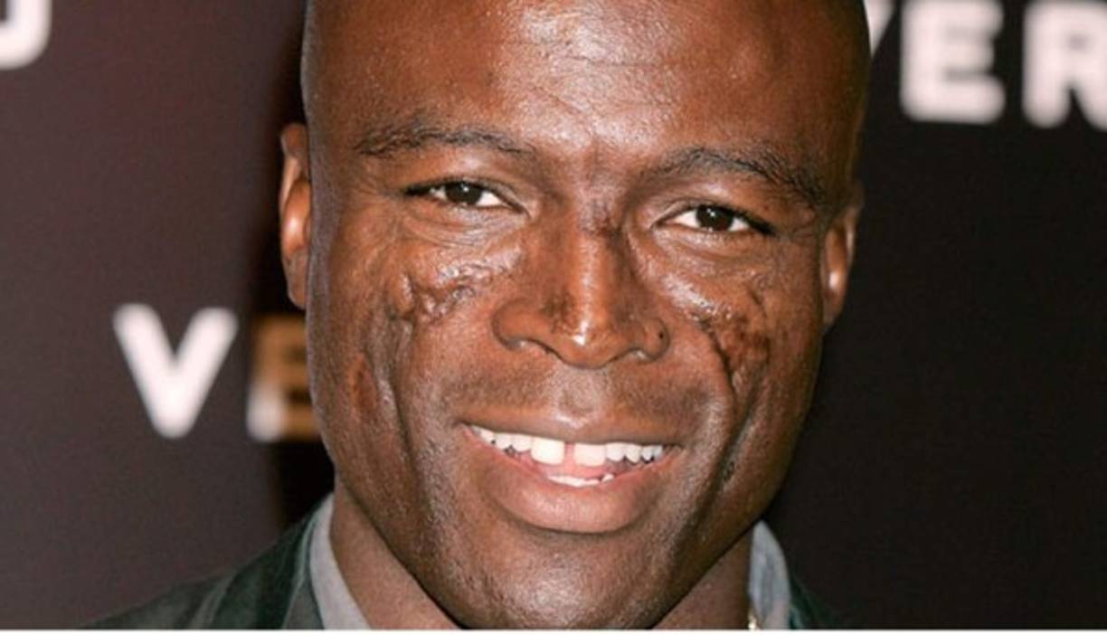 Seal. La cicatrización extrema en la cara y el cuero cabelludo son el resultado de una condición de la piel conocida como lupus eritematoso discoide. Esta enfermedad la tiene desde su adolescencia.<br/>