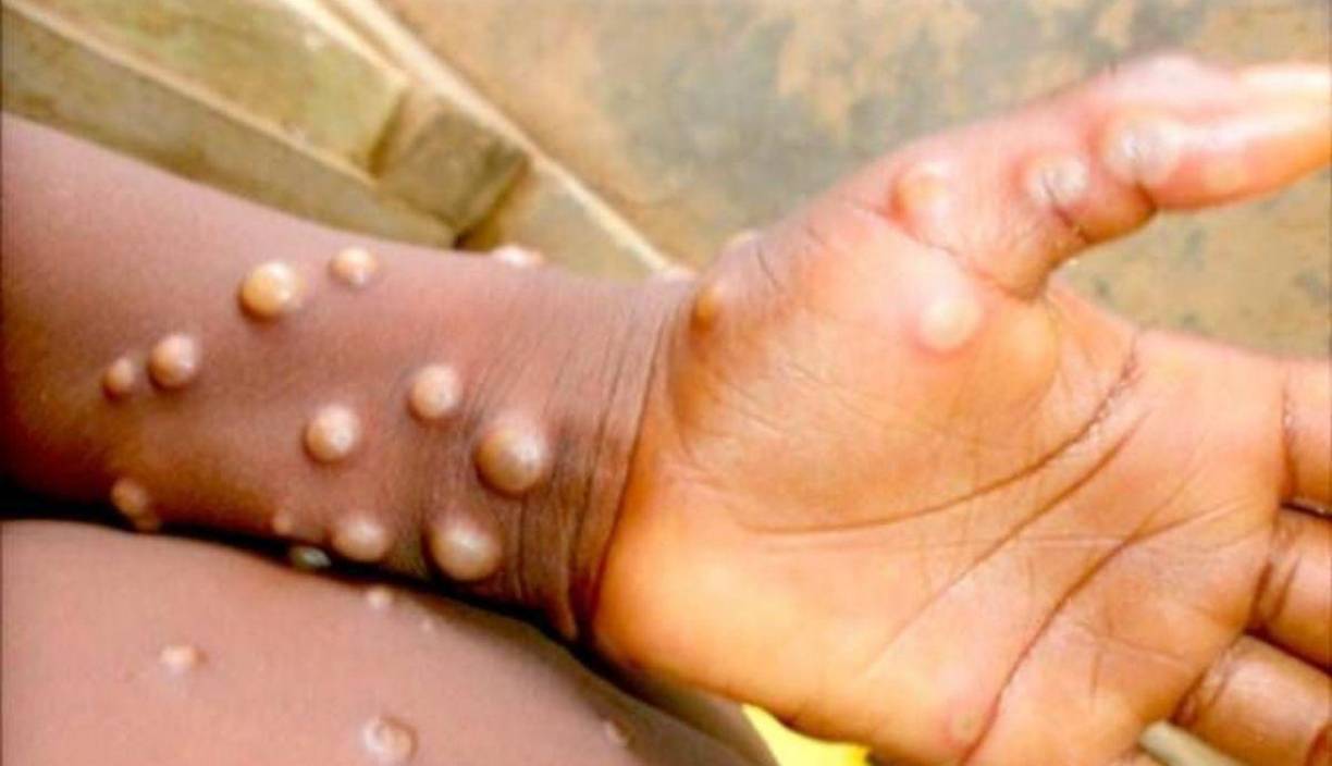 Recientemente, el director general de la Organización Mundial de la Salud (OMS), Tedros Adhanom, declaró nuevamente la emergencia sanitaria mundial por la viruela símica, también conocida como viruela del mono.