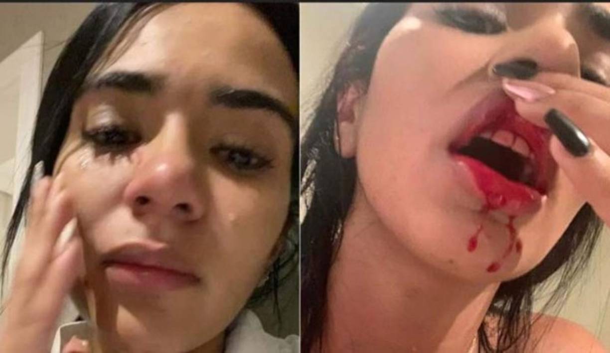 Daniela publicó estas fotos en su cuenta de Instagram en la que señaló que así quedó tras los golpes que supuestamente le dio el jugador colombiano Sebastián Villa.