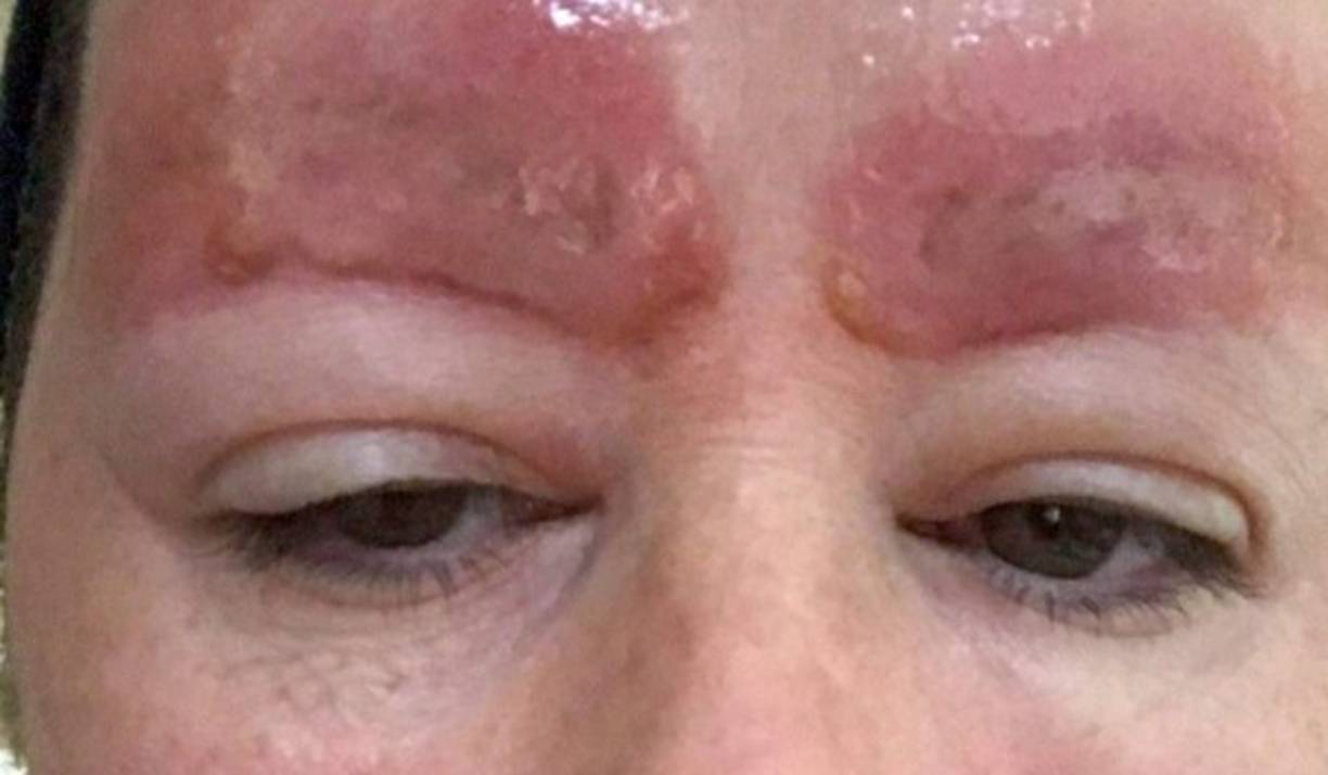 Amanda tuvo que ir al doctor, cosa que le resultó mucho más cara que el tatuarse las cejas, ahora está tomando antibióticos y esteroides para bajar la hinchazón, además de que tiene miedo de que le queden cicatrices difíciles de ocultar.