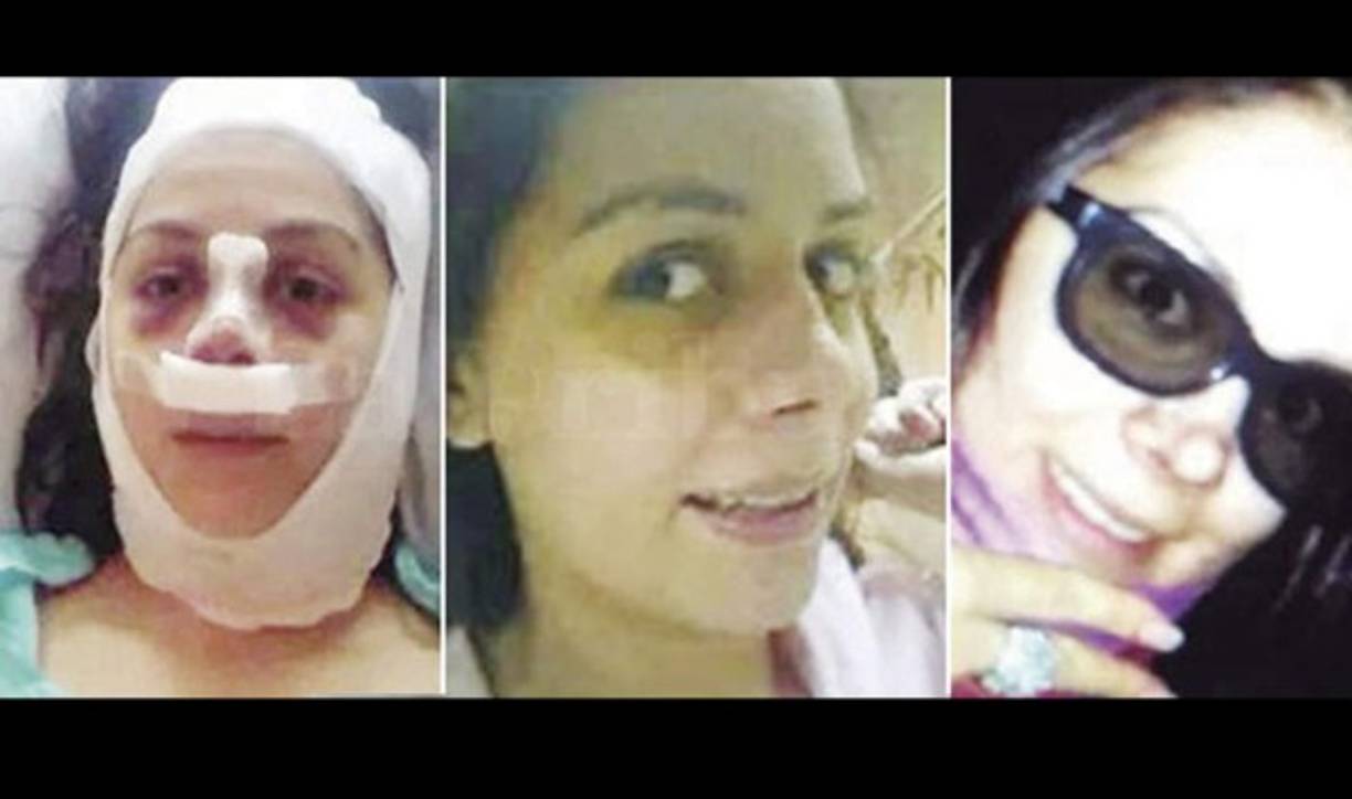 ¡Hasta una rinoplastía se practicó Ilsa Molina!