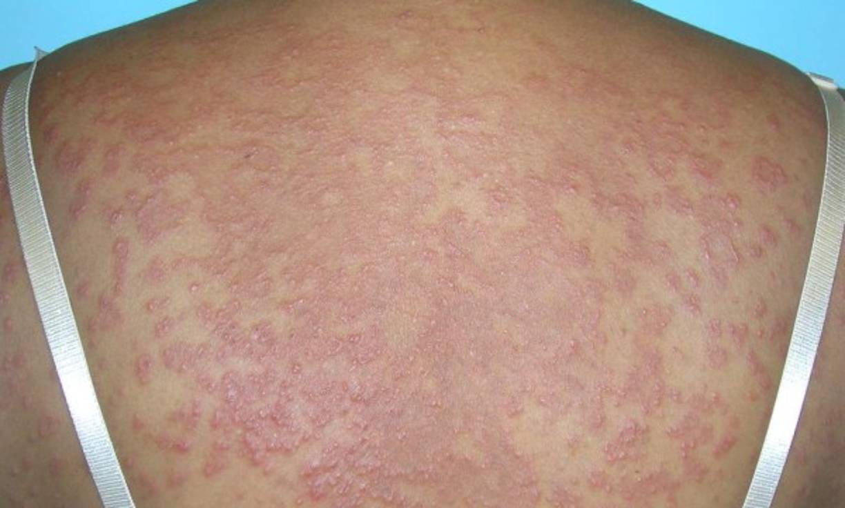 El enrojecimiento de la piel (eritema).