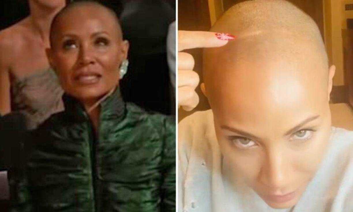 Se trataría de una alopecia ocasionada por una alteración autoinmune que se denomina alopecia areata.