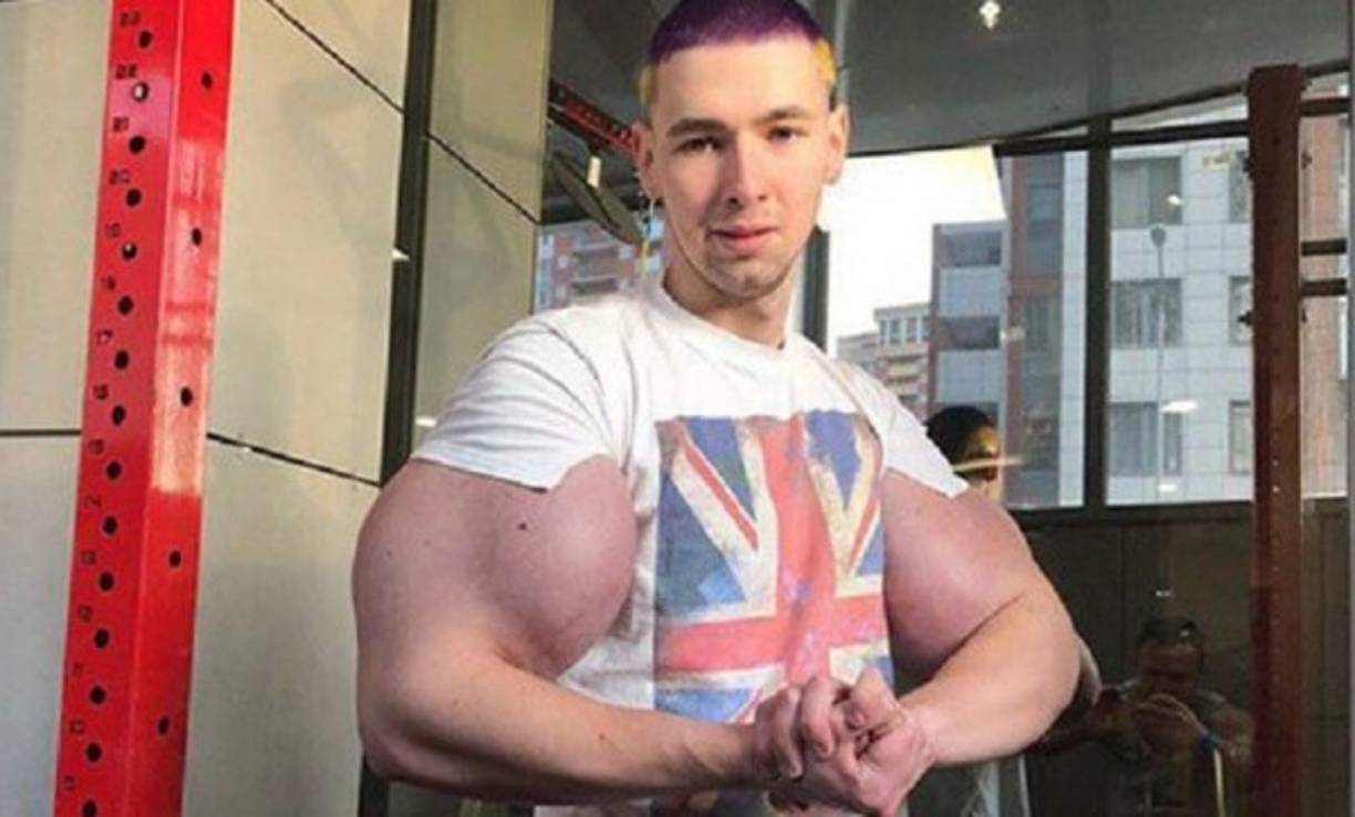 Antes de someterse a la sofisticada operación, el Popeye ruso recibió la colaboración de Alana Mamaeva, una influencer que estuvo en pareja con el futbolista Pável Mamáyev, quien se encargó de reunir los fondos para costear la cirugía