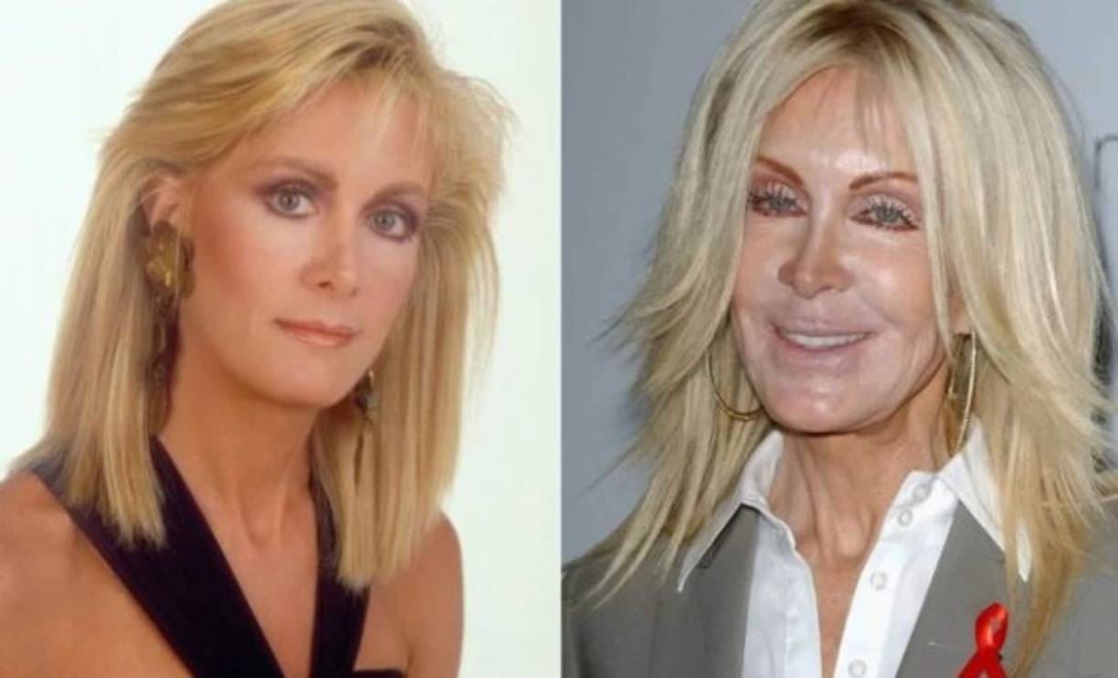 Joan Van Ark: Joan ha tenido una larga carrera como estrella de novelas norteamericanas como Dallas, volviéndose una estrella de la cultura popular americana. Pero su obsesión por la belleza externa, la llevó a volverse el centro de las burlas, luego de aparecer en una alfombra roja con el rostro desfigurado por las intervenciones y la piel descolorida.<br/>
