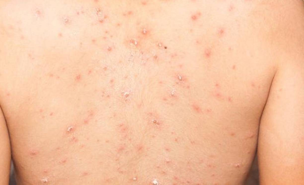 La CDC de Estados Unidos explicó que “cualquier persona, sin importar su orientación sexual, puede transmitir la viruela del mono a través del contacto con fluidos corporales, llagas de viruela del mono u objetos compartidos (como ropa y ropa de cama) que hayan sido contaminados con fluidos o llagas de una persona con viruela del mono”. 