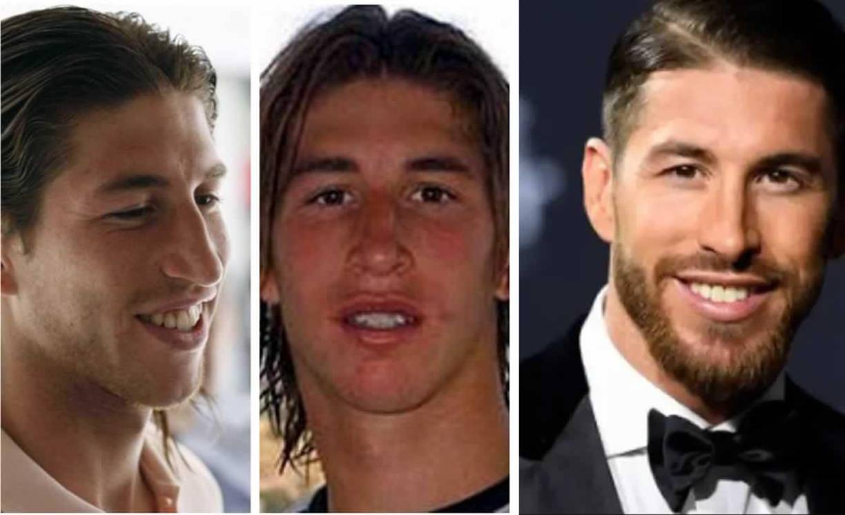 Sergio Ramos - El defensa del PSG es uno de las estrellas que más ha invertido en su aspecto físico y su cambio desde que comenzó su carrera deportiva es impresionante. El ex capitán del Real Madrid no ha descuidado su sonrisa. Hoy en día luce una dentadura reluciente, recta y blanca como resultado de una ortodoncia invisible y de tratamientos de blanqueamiento.