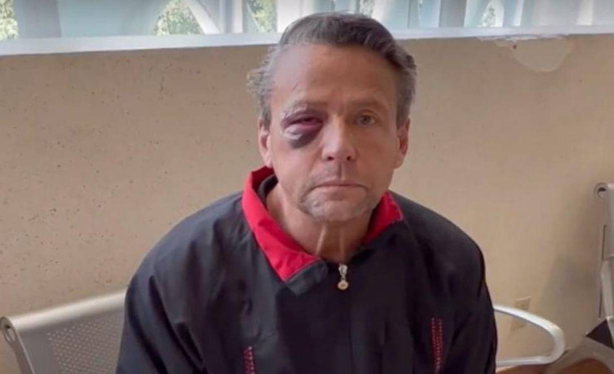 Después de que el actor y conductor Alfredo Adame tuvo una pelea que le dejó diversas lesiones en su cara.