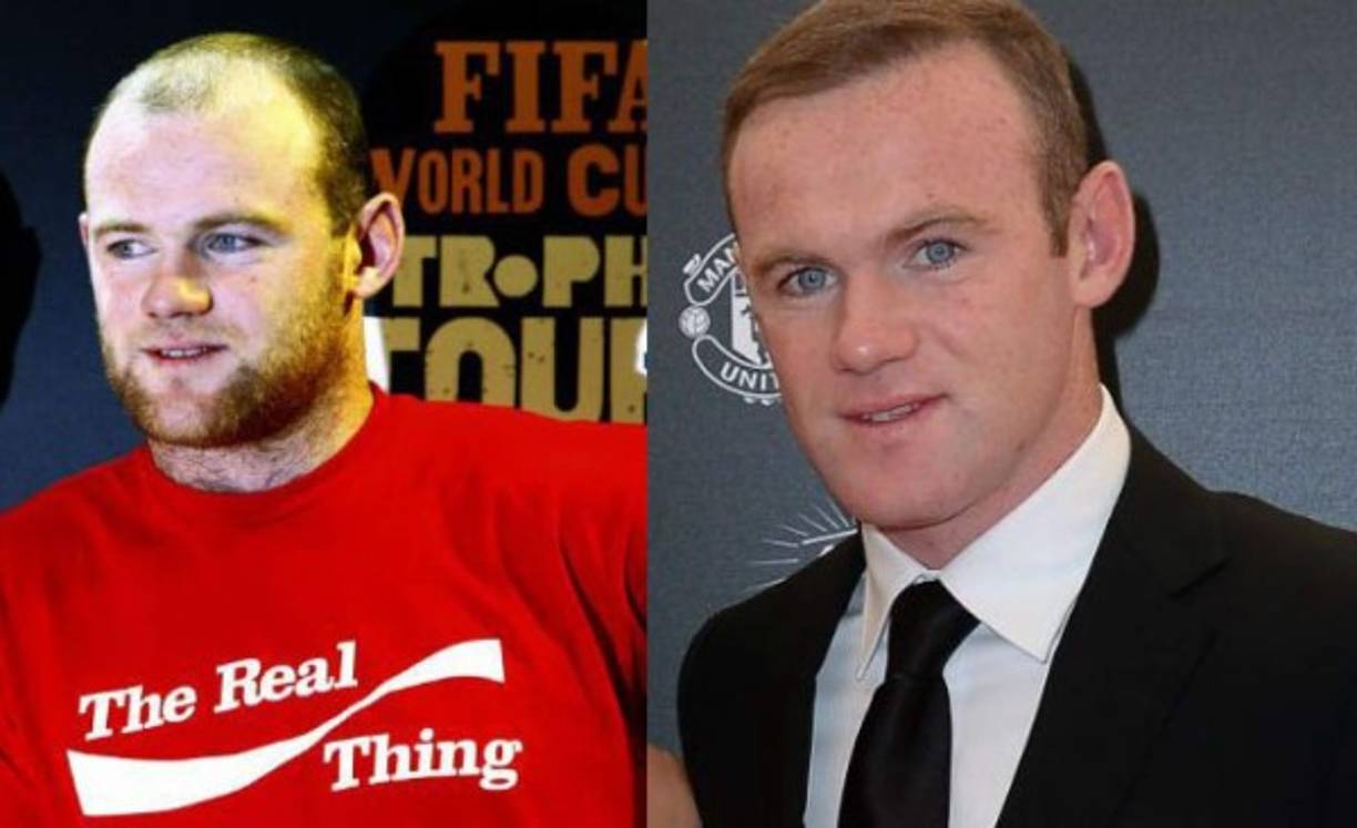 Wayne Rooney: Luego de que estaba quedando sin pelo, el delantero inglés decidió ponerle remedio rápidamente. No dudó en acudir a una clínica para someterse a una operación y poder volver a presumir de pelo sin complejo. Tras la intervención, que le costó cerca de 34.000 euros, fue el propio Rooney el que informó a través de las redes sociales de que pronto notarían cambios en su aspecto.
