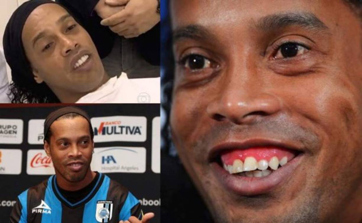 Ronaldinho lució en 2013 nuevo rostro. Invirtió 50 mil euros en una doble cirugía para cambiarse la dentadura. 'Me siento más seguro ahora. Me encanta pasar la lengua por los dientes y mirarme al espejo para comprobar el resultado', dijo.