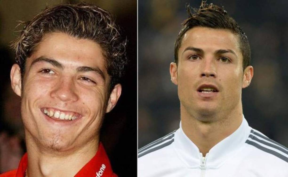 Cristiano Ronaldo acudió hace unos años al cirujano plástico para mejorar su imagen. Al crack portugués le repararon sus dientes desiguales, la piel con acné y ahora es uno de los futbolistas más sexys del mundo.