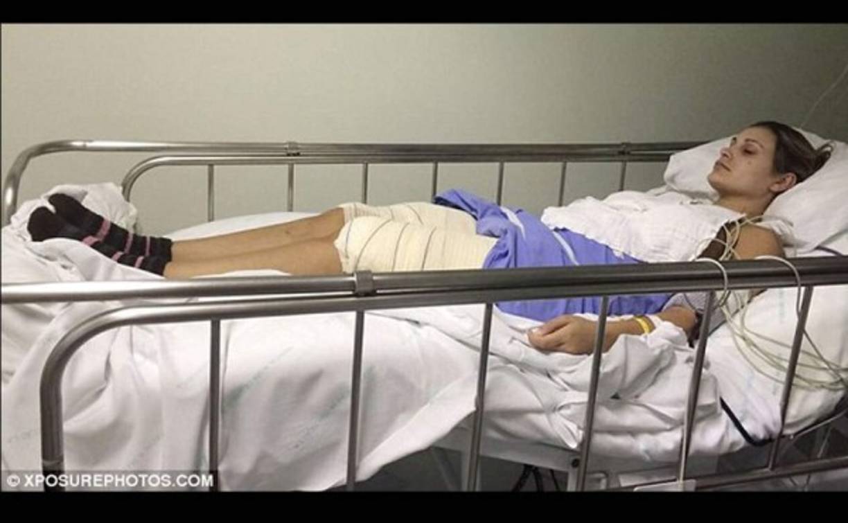 Los estragos de las operaciones para retirar de su cuerpo el hidrogel son impactantes.