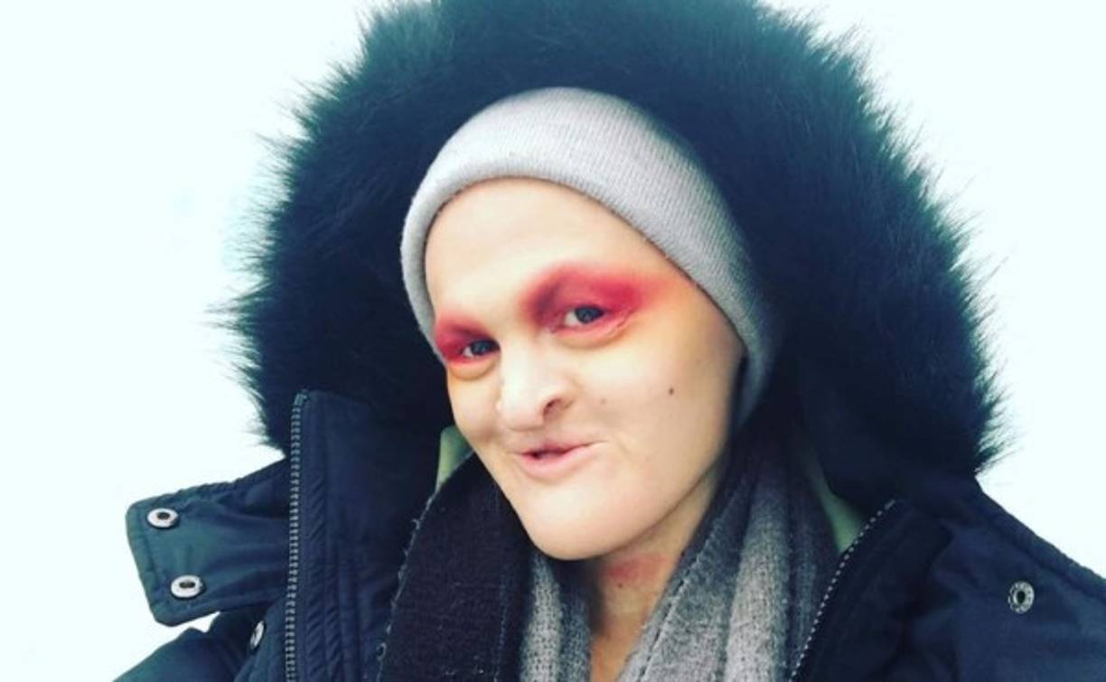 Melanie Gaydos sufre de displasia ectodérmica, un trastorno genético que hace que no tenga dientes y sea calva. <br/>