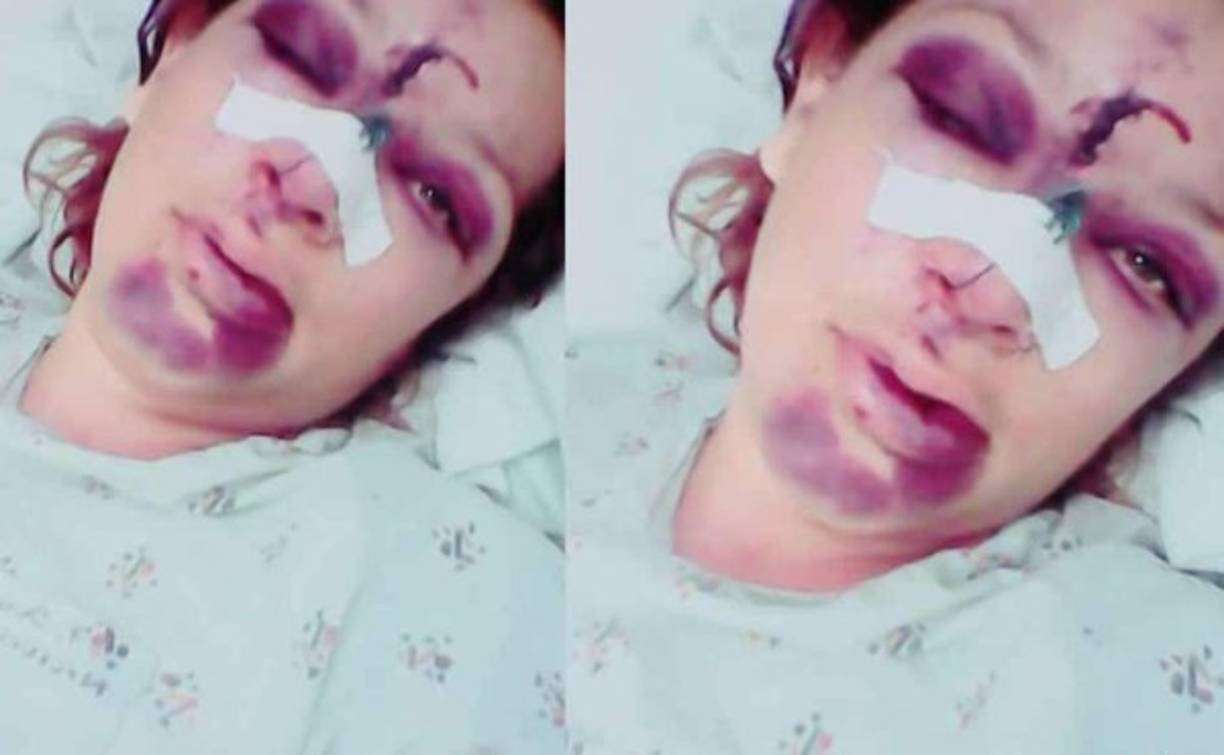 'Él quiso apuñalarme y yo le dije que no, que no lo hiciera por mis hijos ', dijo este lunes Haidy Julissa Rivera (30) a las autoridades del Hospital Escuela Universitario (HEU), después de la golpiza que el sábado pasado le propinó su pareja sentimental. La joven recuerda que todo comenzó al caer la noche cuando Edgar Euceda Diaz llegó a la casa que ella comparte junto a sus tres hijas. 'Él se molestó porque estaba un muchacho en la casa y se puso celoso, me agredió, quiso pelear con el muchacho a quien yo le dije que mejor se fuera para evitar problemas', detalló Haidy desde su lecho de recuperación en el HEU. Con cierta dificultad para articular palabra, la paciente, a quien esta mañana se le evaluó descartando fractura nasal, reveló que cuando ella y su agresor se quedaron solos 'me golpeó la cara por dos veces con el palo del trapeador, puñetazos, me haló el pelo, me tiró al suelo y me siguió golpeándo'.