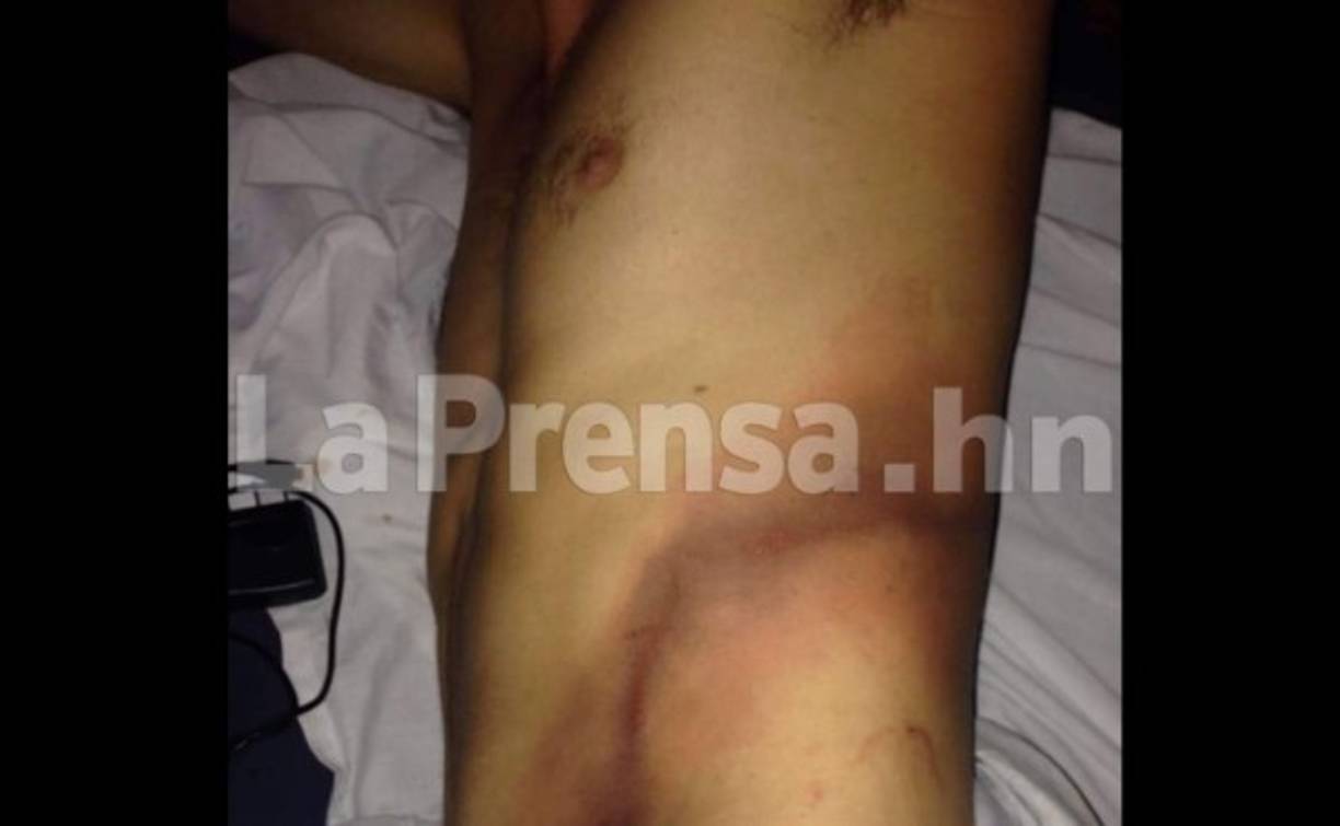 Ángel Rigoberto Mejía sufrió quemaduras en su abdomen tras ser alzanzado por un rayo en el barrio Erandique de Lempira.