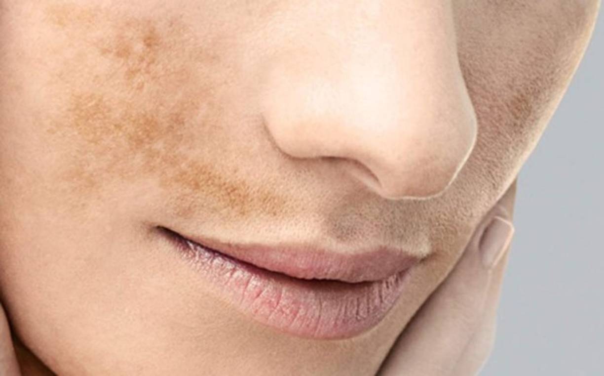 Oscurecimiento de la piel (hiperpigmentación).