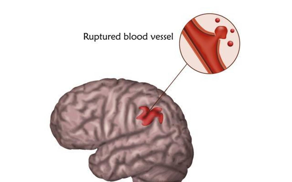 Los accidentes cerebrovasculares isquémicos también pueden ser causados por una sustancia pegajosa llamada placa que puede taponar las arterias.