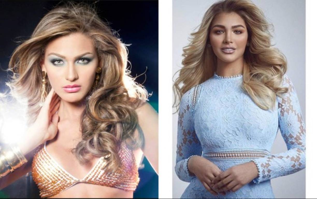 Las fotos que datan desde sus años como reina de belleza a la actualidad también constatan que Migdelis no ha dejado de servirse del bisturí.<br/><br/>La nueva conductora de Univision ha continuado afinando su nariz, su mentón y moldeando sus mejillas.