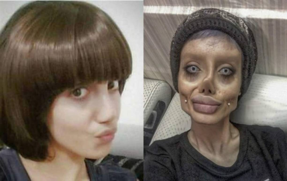 La joven de Teherán se sometió a 50 cirugías en tan solo unos pocos meses, según el sitio web belga Sud Info.