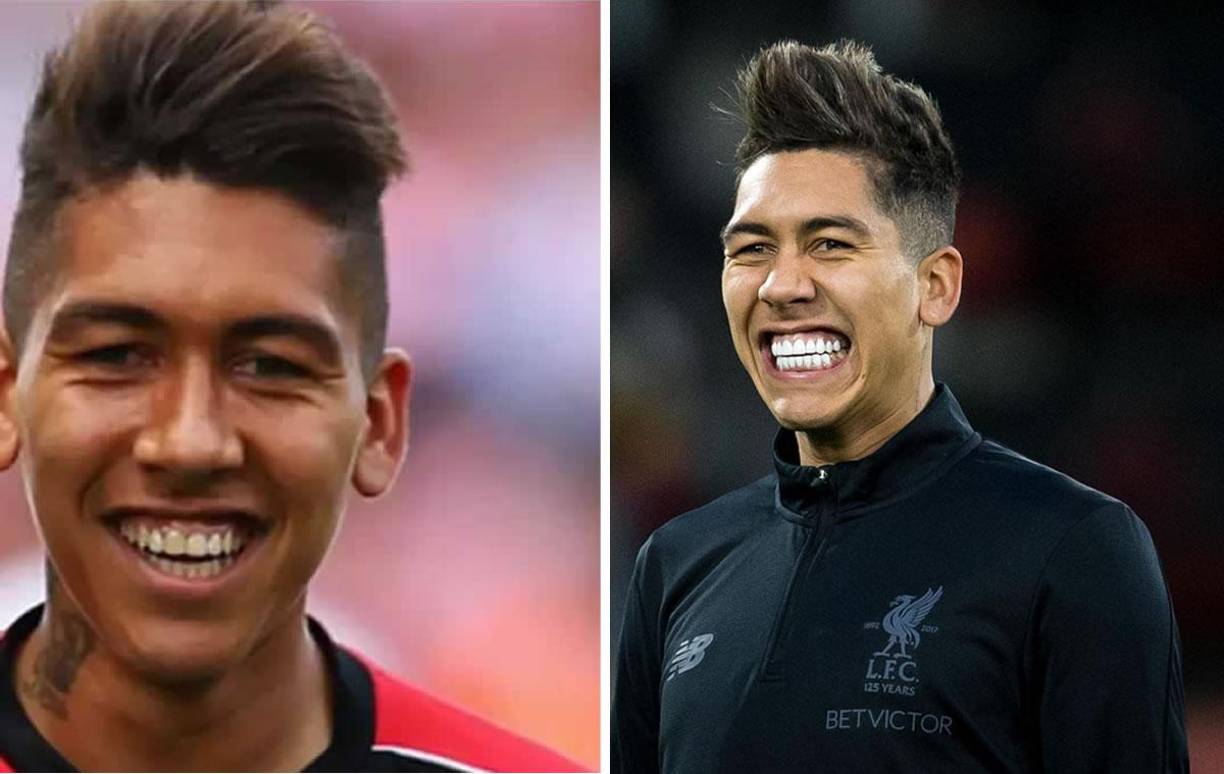 Roberto Firmino - El jugador del Liverpool no solo es reconocido por su goles sino por su impactante sonrisa. A juzgar por las fotos de cuando llegó a Inglaterra, el brasileño ha blanqueado su dentadura y se ha sometido a un tratamientos de coronas o carillas dentales.