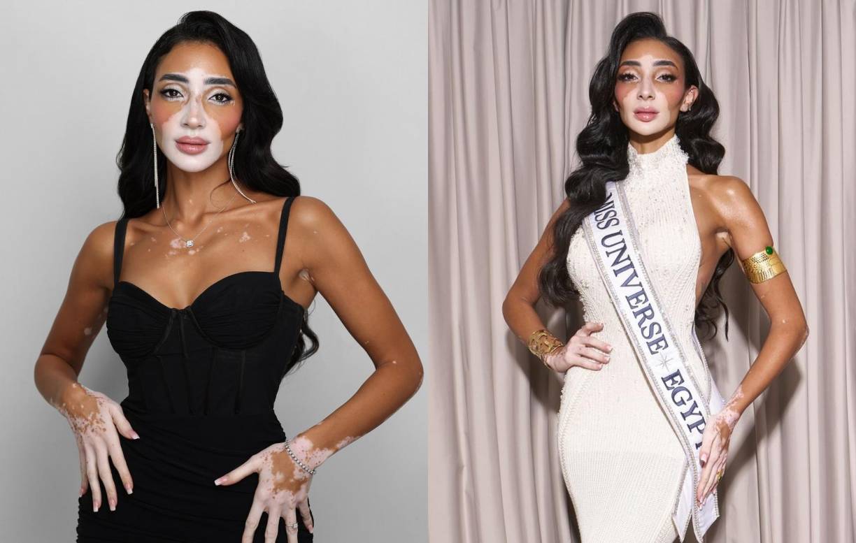 El nombramiento de Logina Salah como Miss Egipto 2024 no pasó desapercibido, pues se trata de la primera mujer con vitiligo en ganar el título nacional y también la primera en participar en la historia de Miss Universo. 