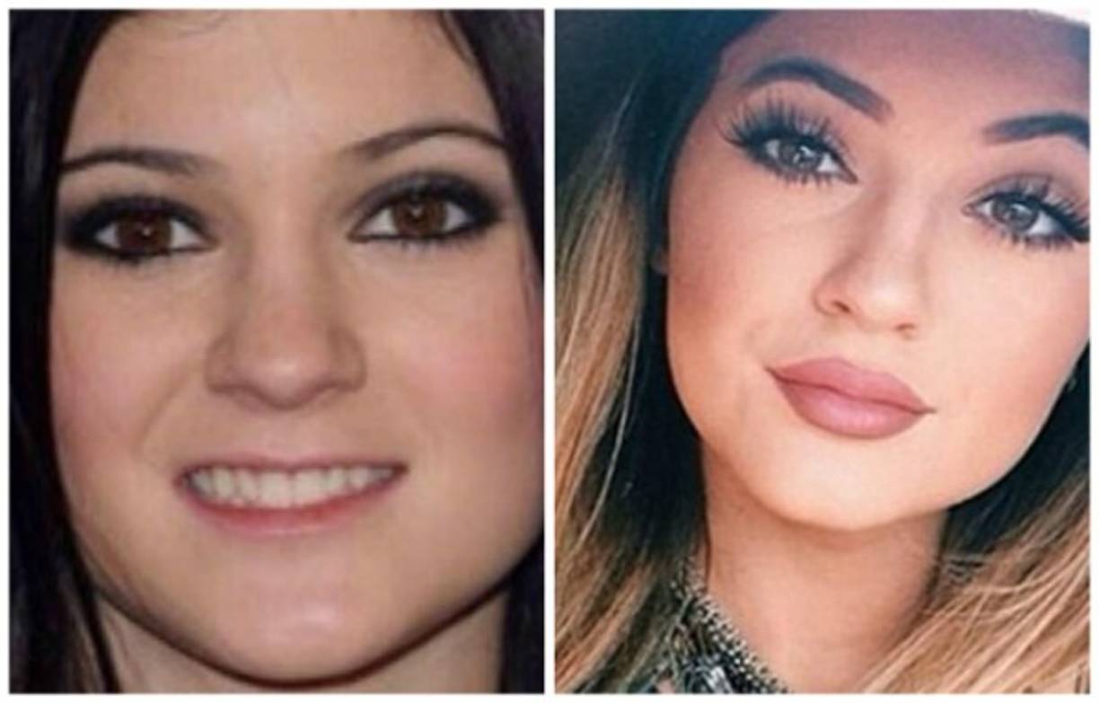 Kylie transformó sus labios por completo.
