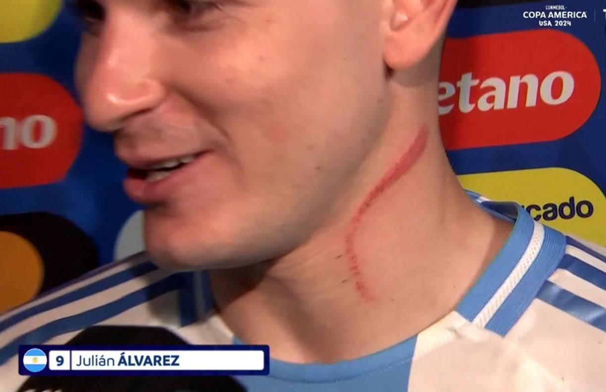 Así le quedó la tremenda marca en el cuello a Julián Álvarez tras el partido debut de Argentina ante Canadá.