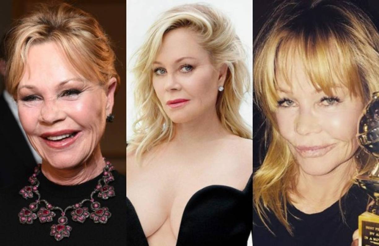 Otros expertos recuerdan que la actriz tiene cáncer de piel, cómo ella misma confesó tiempo atrás.<br/><br/>'Eso explicaría el estado del rostro aunque en su caso hay que afirmar que ha hecho todo por verse joven a cualquier precio por lo que se ha convertido totalmente en otra persona', agrega el doctor Gustavo González Zaldívar, experto en cirugía plástica.<br/>