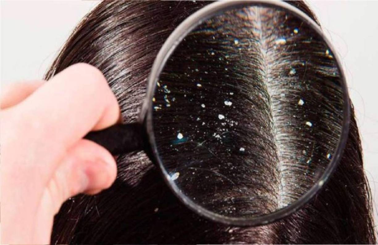 El problema de la caspa se puede controlar siguiendo una serie de rutinas y productos para el cuidado del cabello, pero también con una serie de remedios caseros.