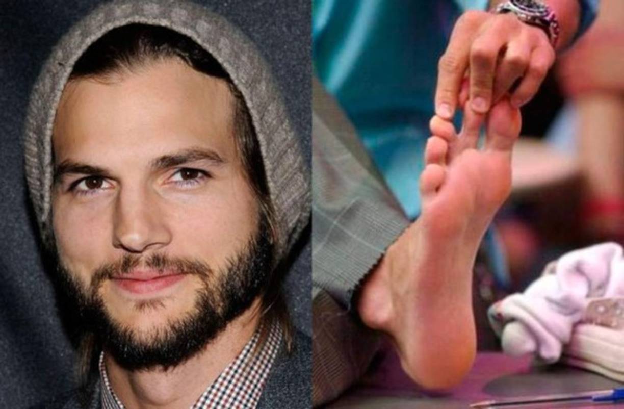 El guapo Asthon Kutcher ha mostrado al mundo el problema en su pie. Dos dedos los tiene casi unidos, pero para él esto no representa ningún impedimento. Cuando le han preguntado, él hace chiste de esto.