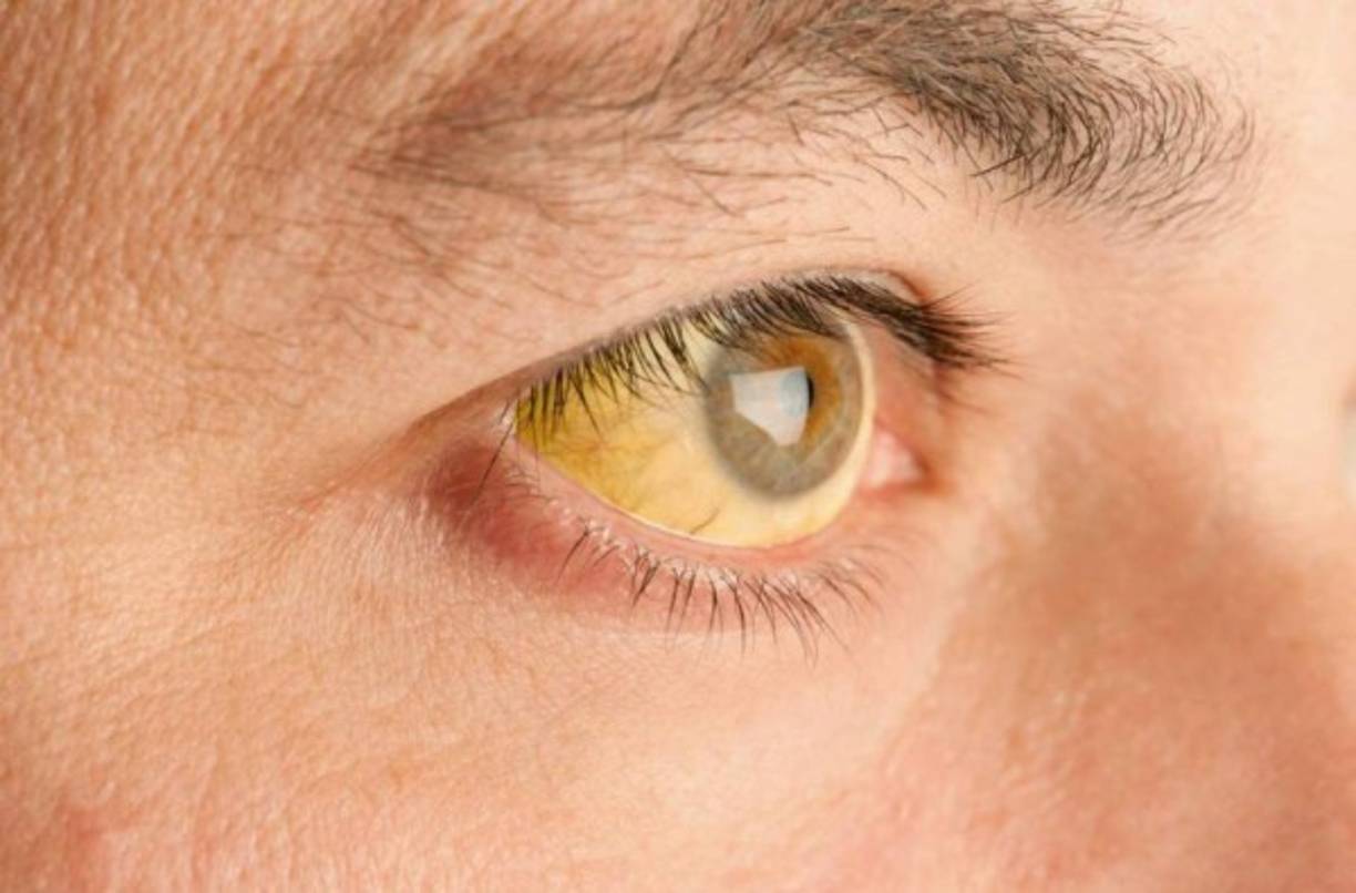 Coloración amarillenta de la piel y de los ojos (ictericia).