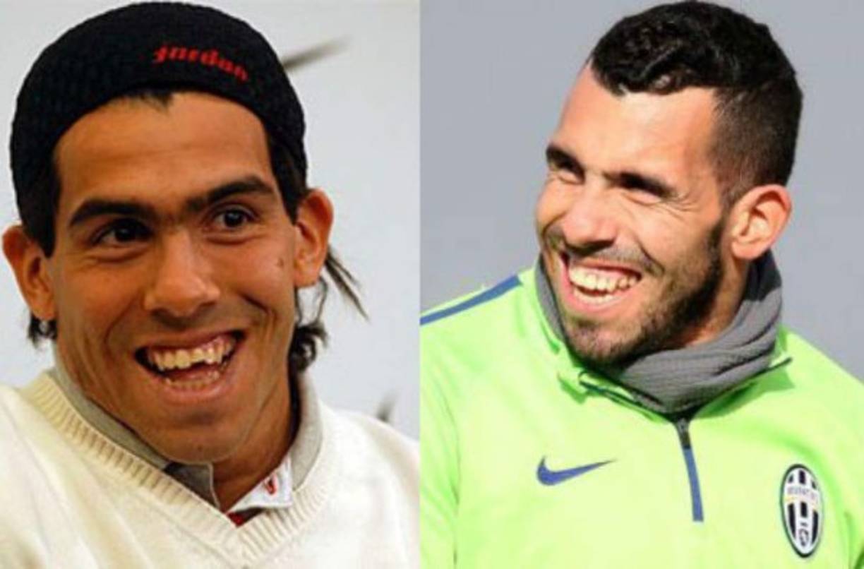 Carlos Tévez: El delantero argentino ha sido uno de los que más se ha sometido a diferentes cirugías estéticas.