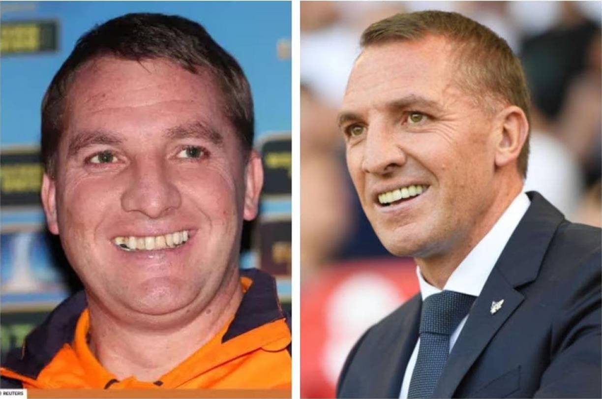 Brendan Rodgers - El entrenador norirlandés, actualmente en el Leicester City de la Premier League, se decidió tarde pero se puso en manos del dentista para lograr un aspecto rejuvenecedor.