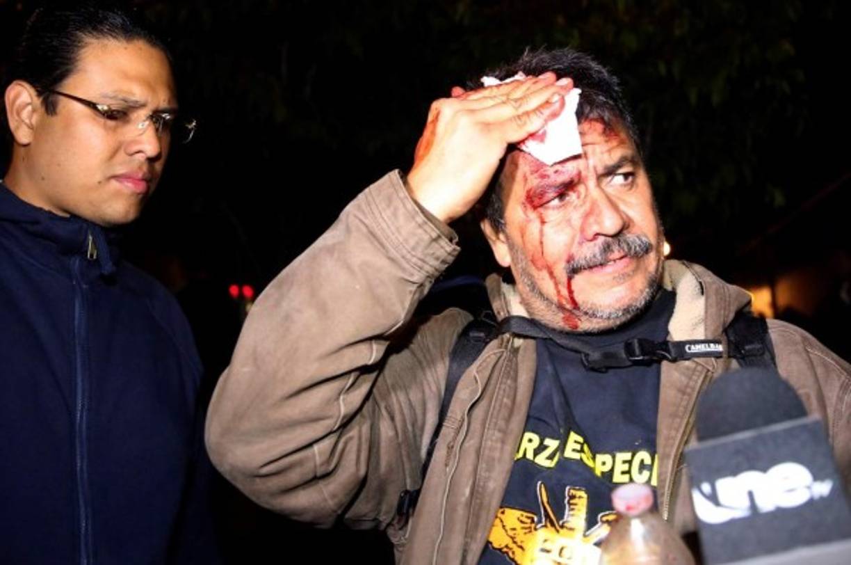 Un simpatizante del candidato opositor Salvador Nasralla, herido durante los enfrentamientos que se produjeron entre grupos de seguidores del candidato opositor Salvador Nasralla y las fuerzas de seguridad frente al centro de computo electoral este 30 de noviembre de 2017 en Tegucigalpa. EFE