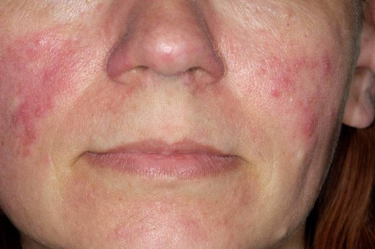 Este ungüento también ha sido utilizado para tratar rosácea o manchas rojas en la piel. Simplemente se aplica una pequeña cantidad de Vicks en el área afectada antes de ir a dormir y otra capa al levantarse. Recuerda que en este caso, es mejor visitar un médico especializado. <br/><br/>