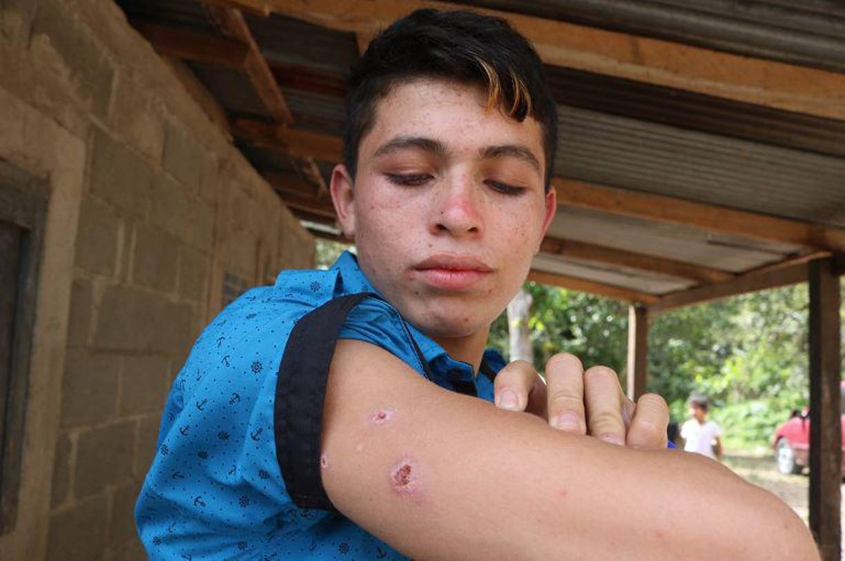 En 2023 se registraron 3 casos de leishmaniasis en las tres primeras semanas de enero. 