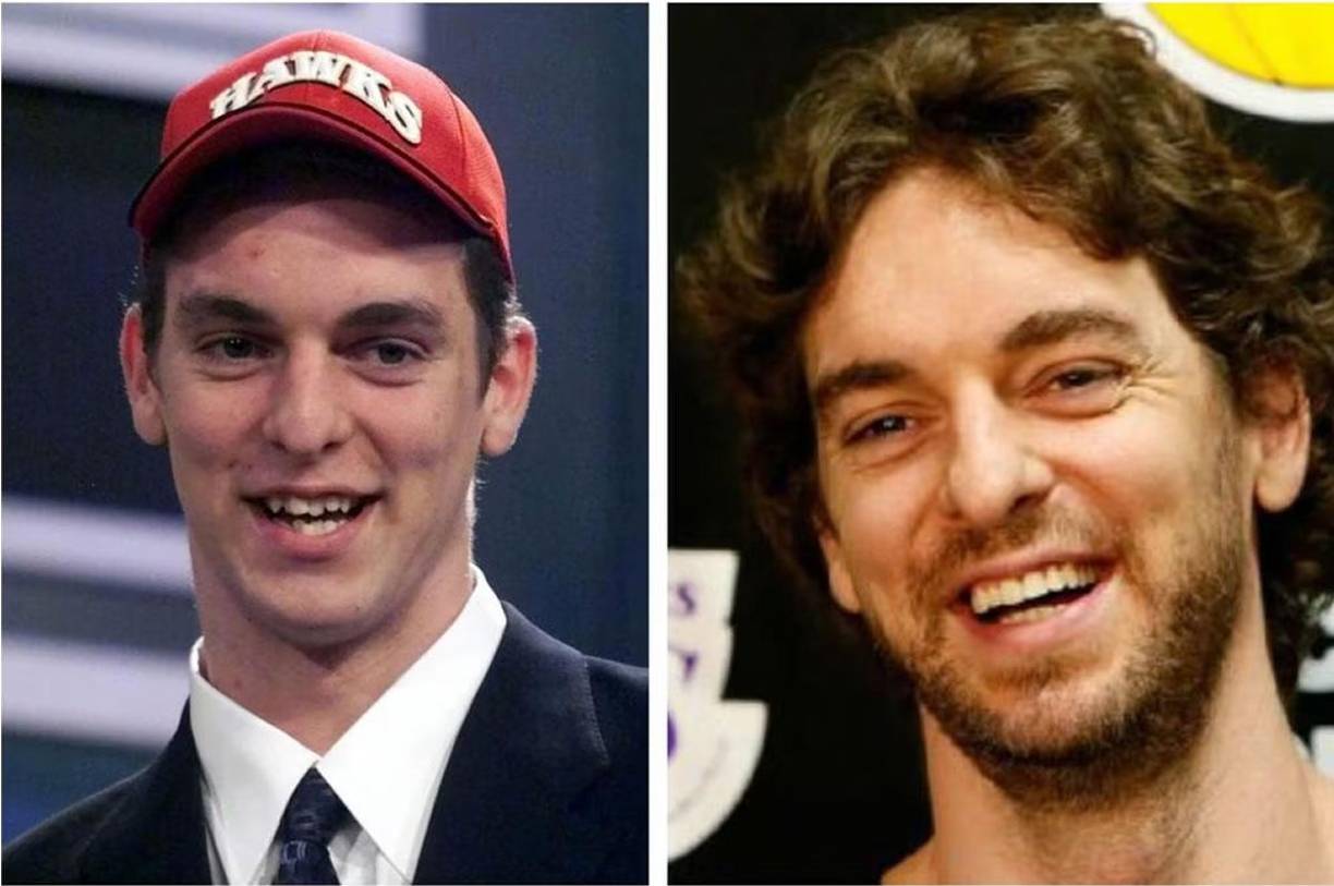Pau Gasol - El dos veces campeón de la NBA con Los Angeles Lakers modificó el aspecto y la colocación de sus dientes después de su llegada a la mejor liga de baloncesto del mundo.