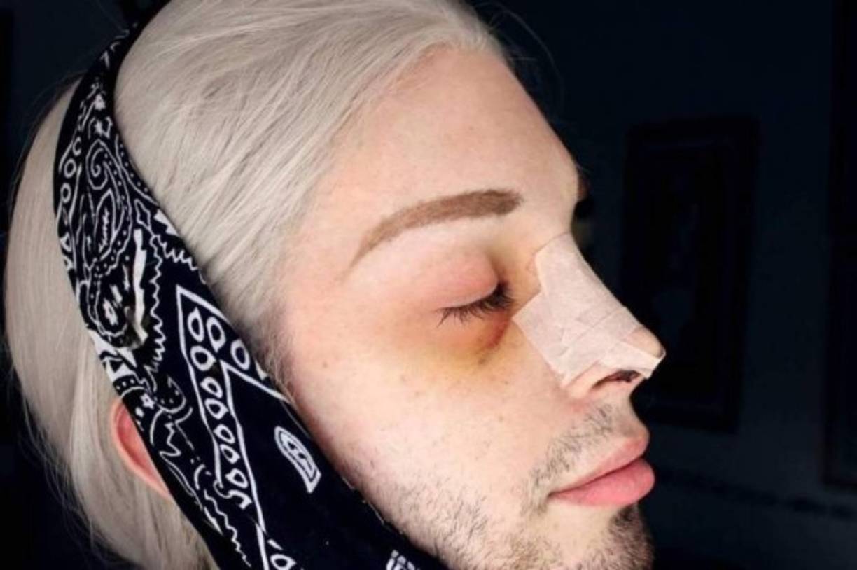 Una de las principales cirugías a las que se ha sometido Luis es la de nariz.